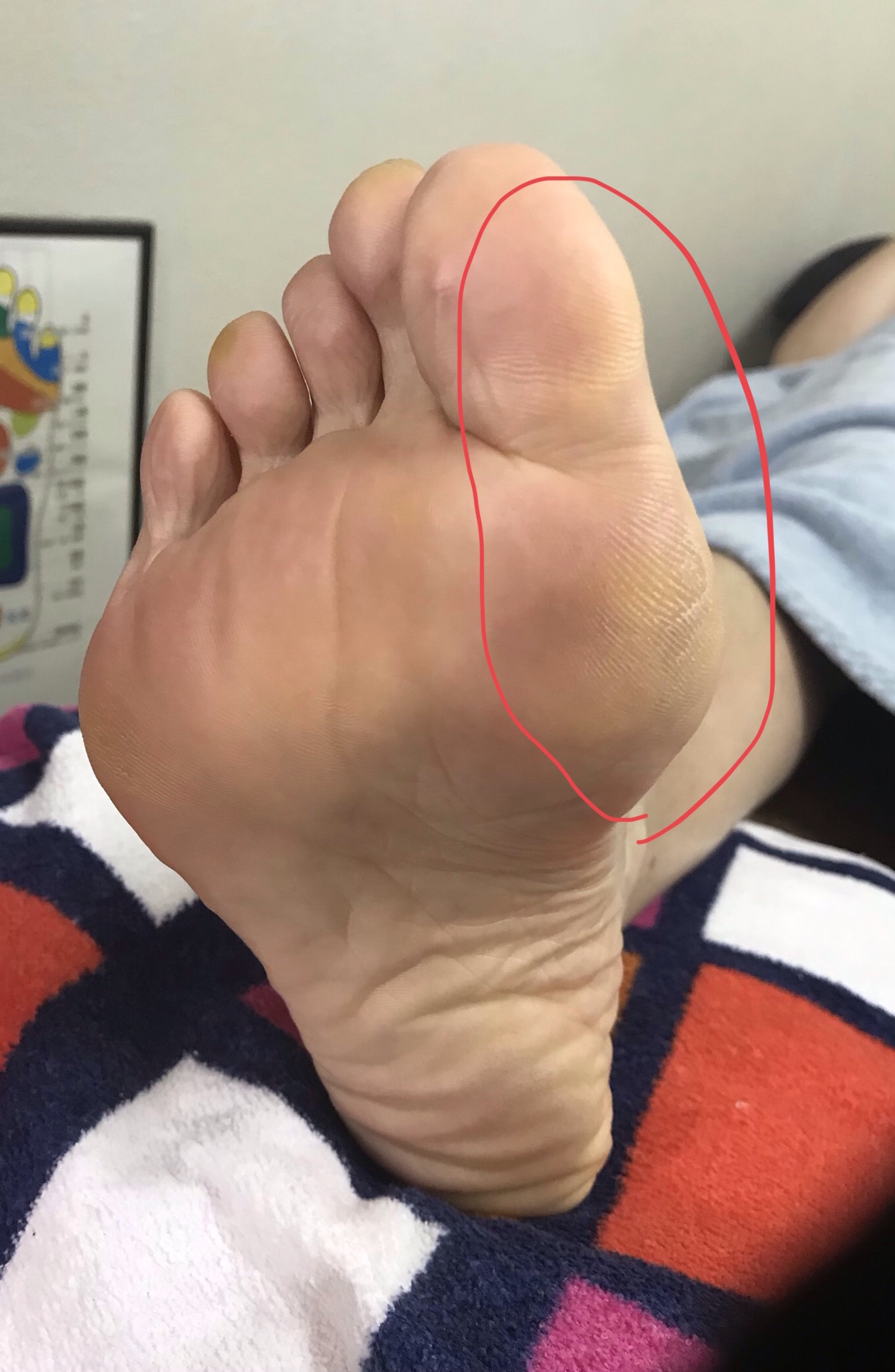 足に現れる身体のサイン…親指の外側側面に角質、その下に角質、親指の付け根に角質