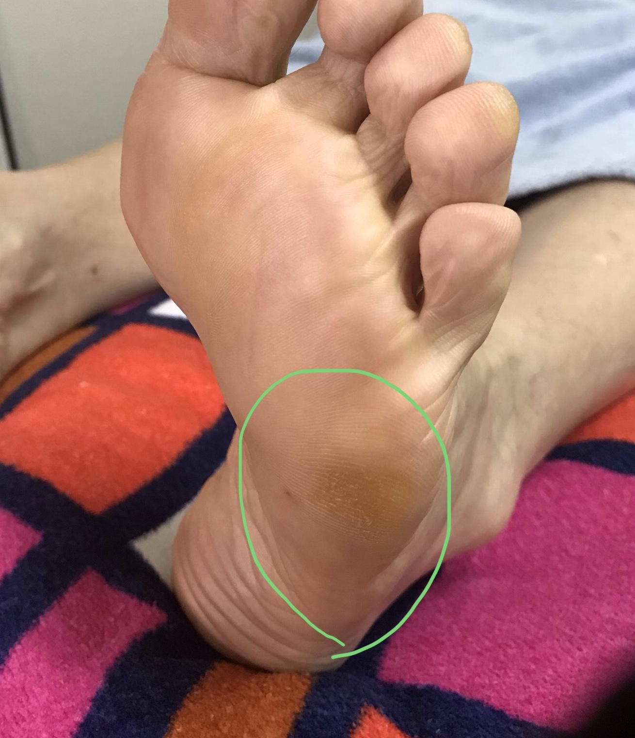 足に現れる身体のサイン…小指側の側面